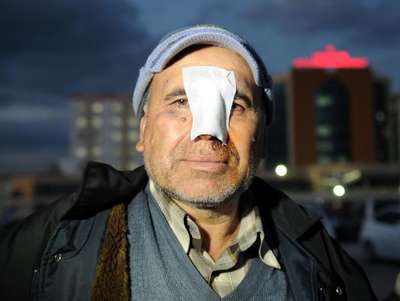 5 hastane dolaştı ama burnundaki yaraya dikiş attıramadı
