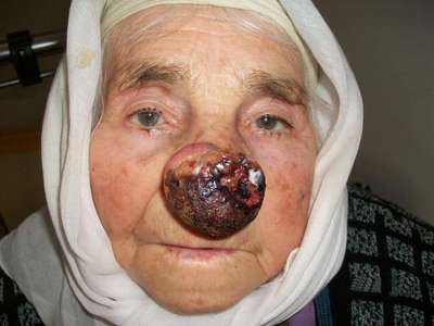 Zehra Nine'ye nefes aldıran operasyon