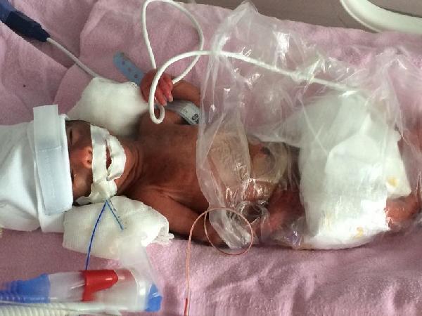 670 gram doğan bebek helikopterle Ankara’ya sevk edildi