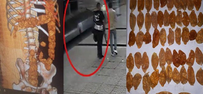 Alman yolcunun midesinden 54 prezervatif çıktı
