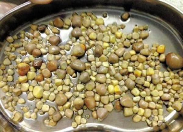 Böbreğinden 420 taş çıkarıldı