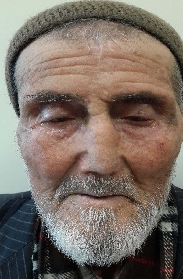 Yaşlı hastaya alnından alınan dokuyla burun yapıldı