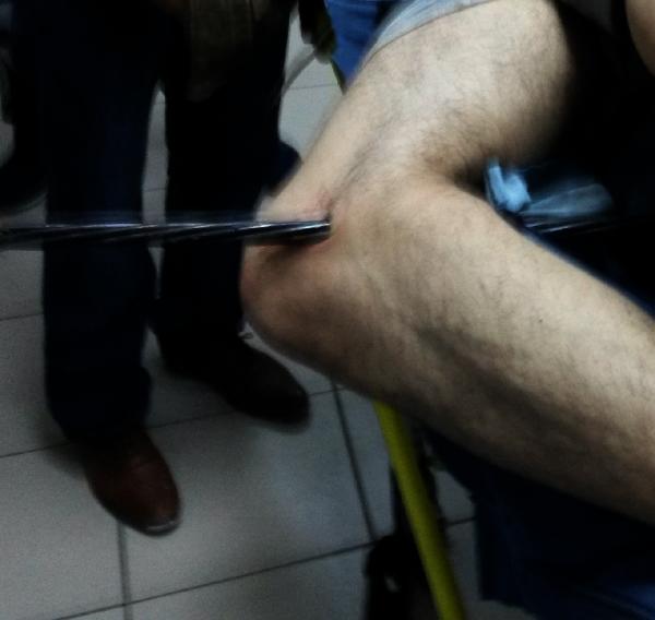 Bacağına bacağına saplanan, 1 metrelik çelik halatla hastaneye getirildi