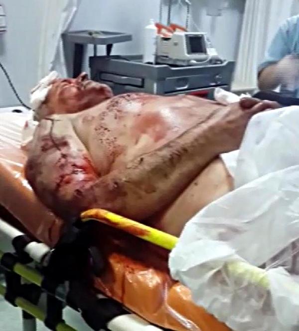 Bekçinin köpek saldırısında parçalanan kulağı alındı