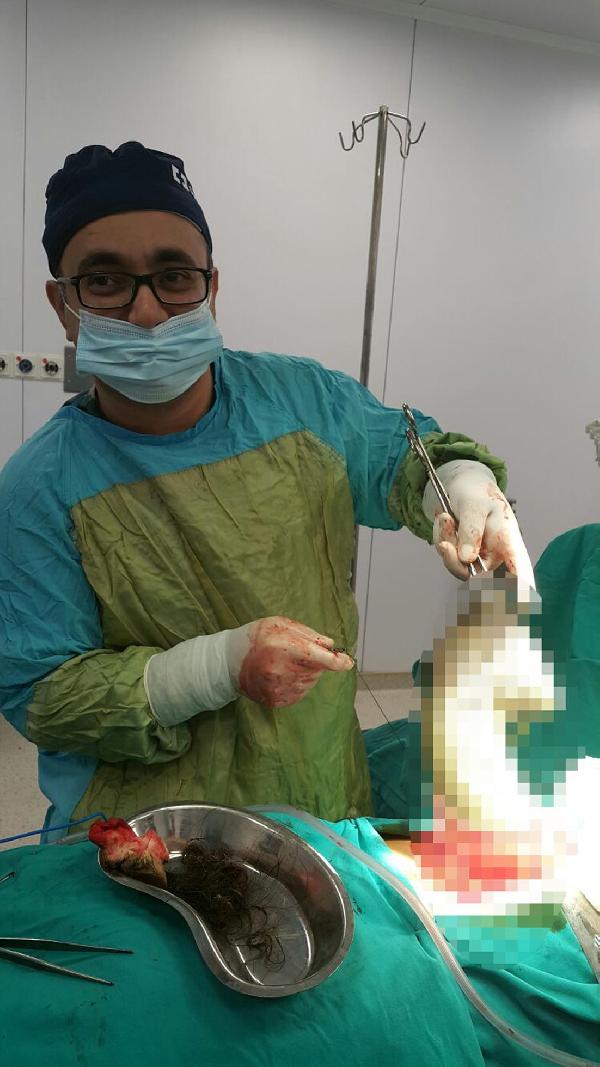 Genç kızın midesinden 1.5 kilogram saç çıkarıldı
