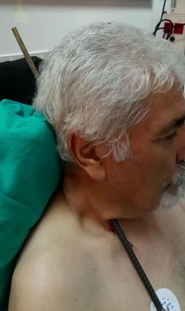 Boynuna saplanan 6 metrelik inşaat demiri, ameliyatla çıkarıldı