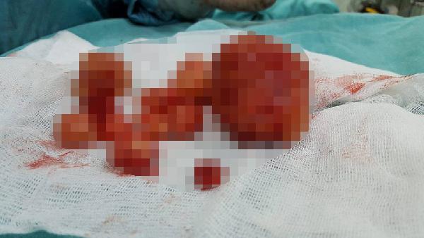 Hastaneye 'Çocuğum olmuyor' diye gitti, rahminden 1 kilo ur çıktı