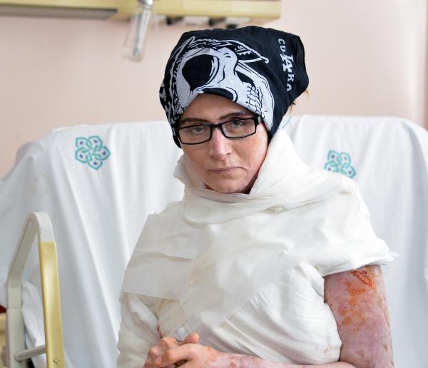 Eşinin kezzaplı saldırısına uğrayan 2 çocuk annesinin yaşam mücadelesi