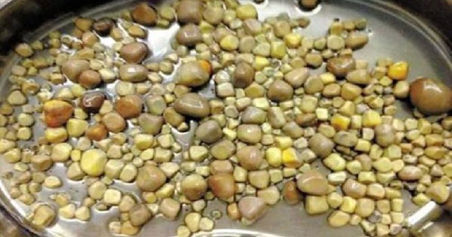 Böbreğinden 420 taş çıktı