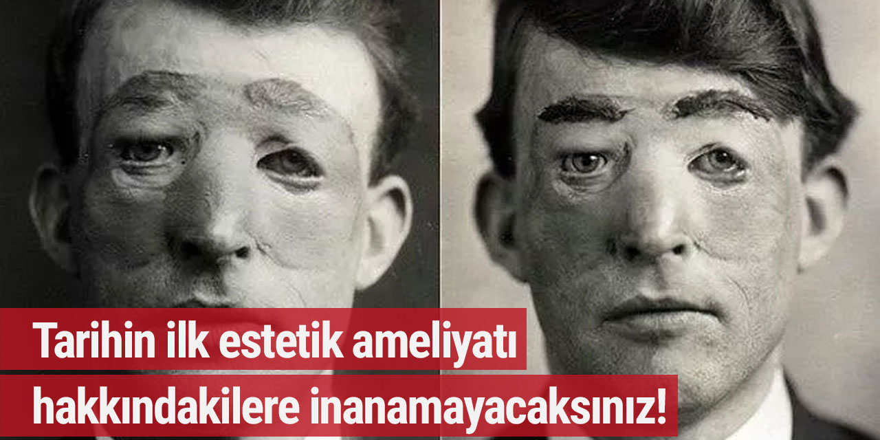 Tarihin ilk estetik ameliyatı hakkındakilere inanamayacaksınız!