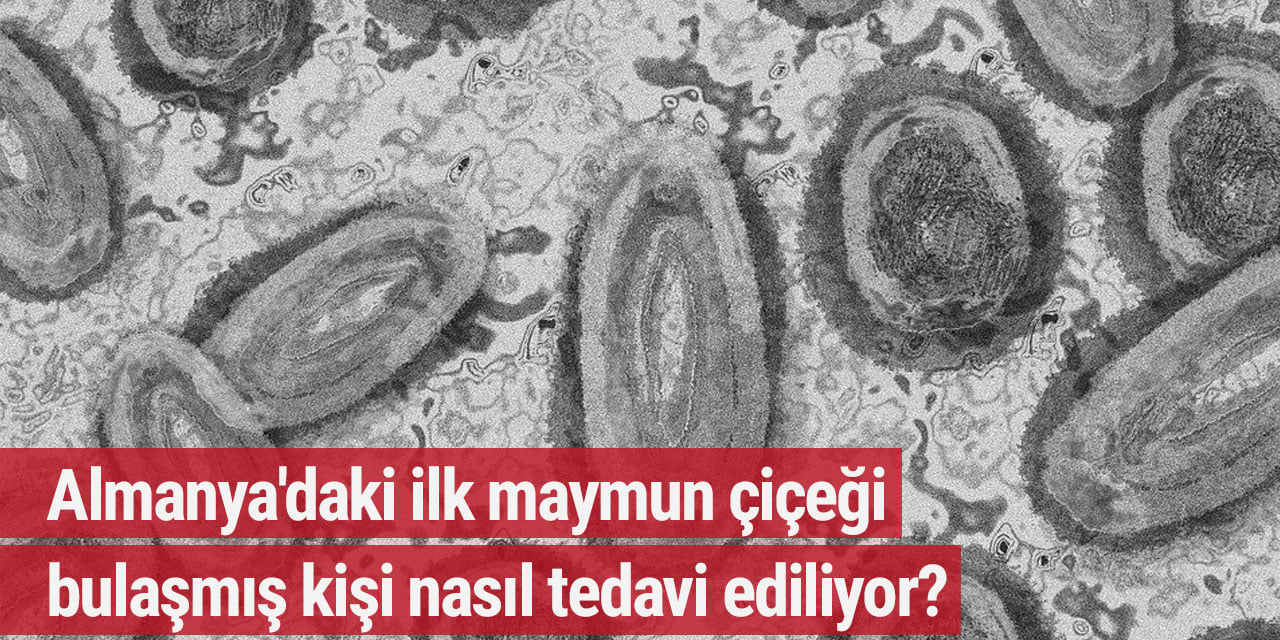Almanya'daki ilk maymun çiçeği bulaşmış kişi nasıl tedavi ediliyor?