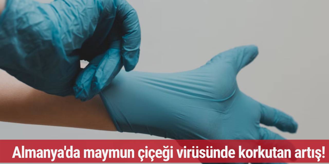 Almanya'da maymun çiçeği virüsünde korkutan artış!