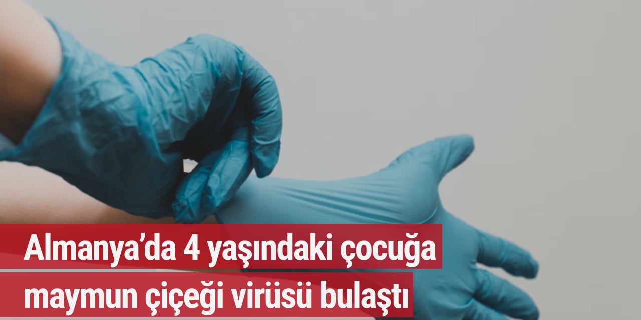 Almanya’da 4 yaşındaki çocuğa maymun çiçeği virüsü bulaştı