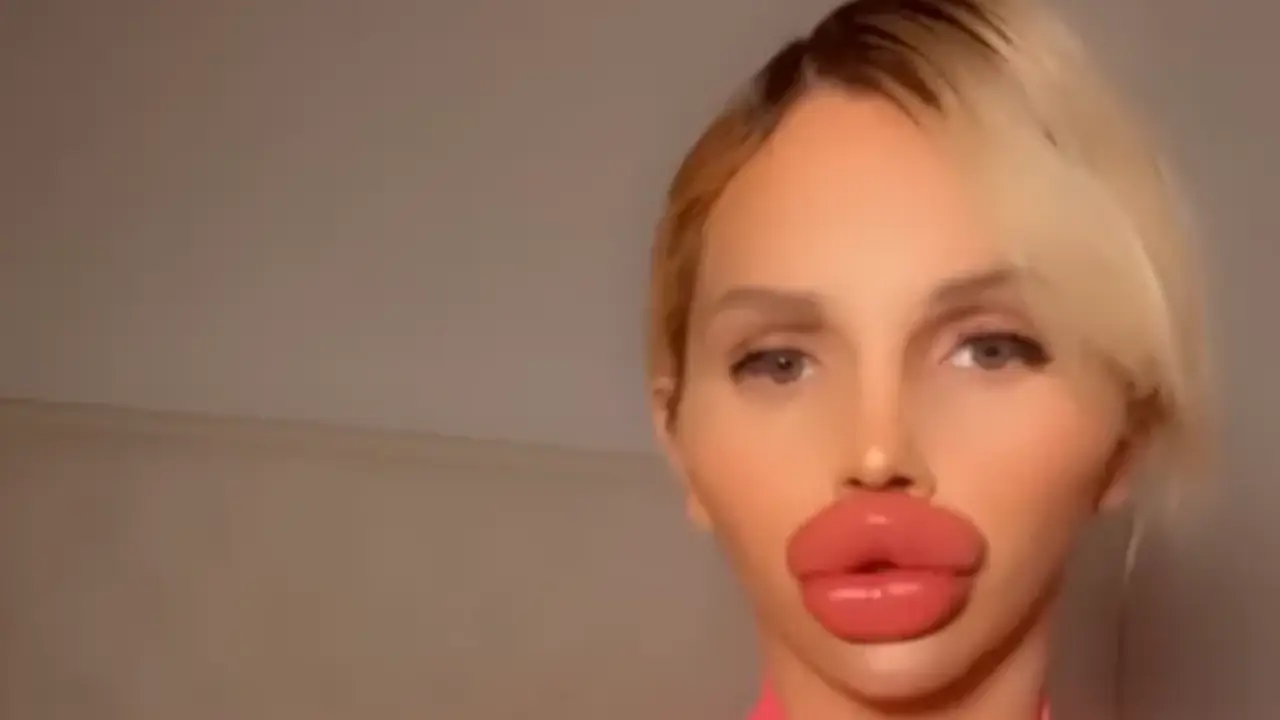 TikTok fenomeni dudakları için ayda 15 bin Euro harcıyor