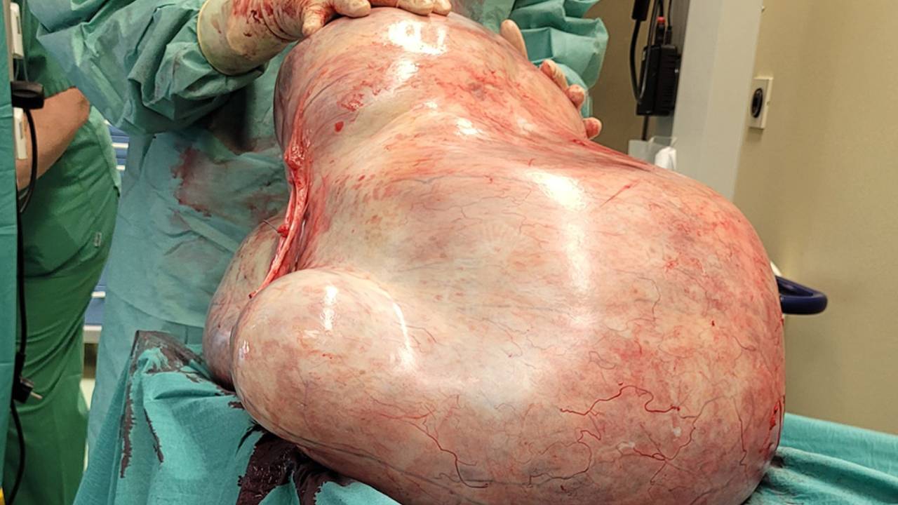 Ameliyat olmaktan korktu, karnındaki tümör 32 kg ağırlığına ulaştı