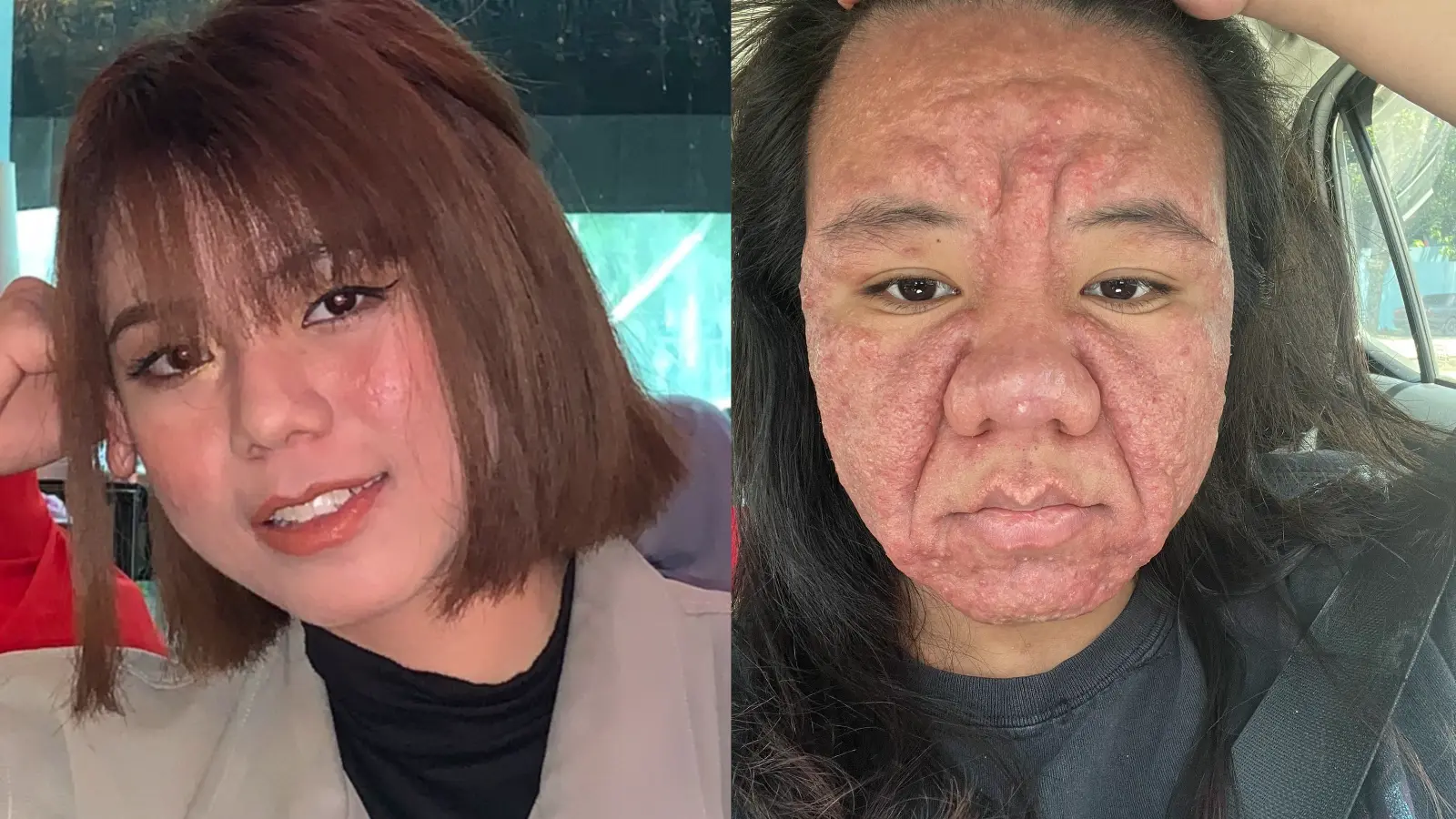 Hamilelikte yüzü değişen kadın yaşadıklarını anlattı