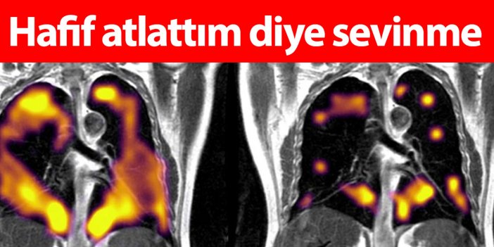 Bilim dünyası şokta... Covid-19’u hafif geçirenlerin akciğerlerindeki gizli hasar ortaya çıktı